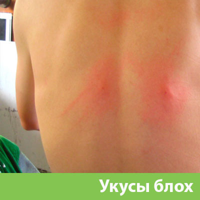 Укусы блох в Ханты-Мансийске