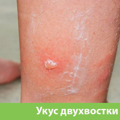 Укус двухвостки в Ханты-Мансийске