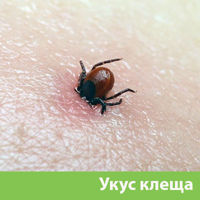 Укус клеща в Ханты-Мансийске
