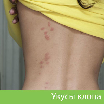 Профессиональное уничтожение клопов в Ханты-Мансийске